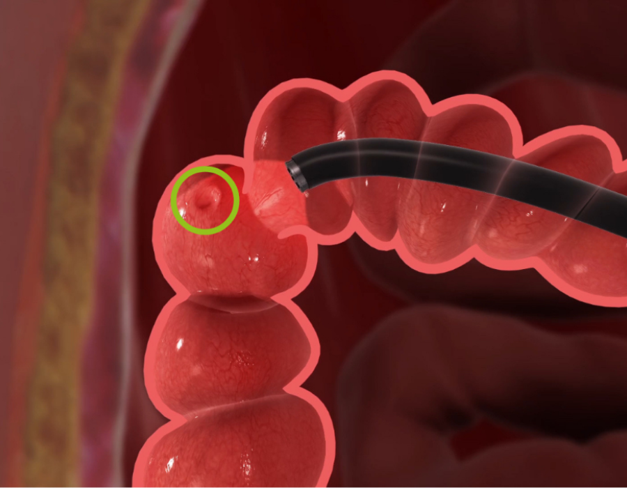 polyp in colon